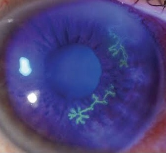 Full examination of Cornea and external eye diseases